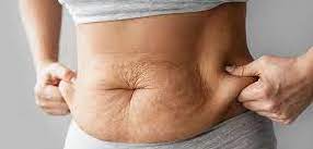 Liposuction and Fat Grafting in Mumbai